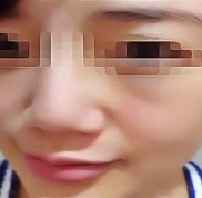 遂寧河?xùn)|眼科近視手術(shù)價格